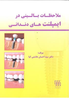 ملاحظات بالینی در ایمپلنت های دندانی
